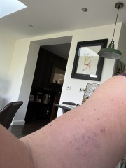 Small purple bruises on arm keep coming back