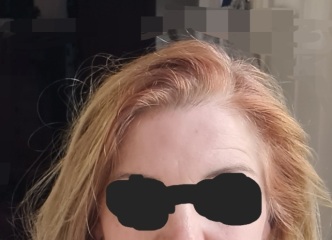 Newly allergic to hair colour, after 25 years!