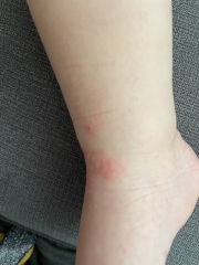 Chickenpox or HFMD? Pic included