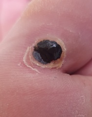 Is this a verruca still?? Picture attached