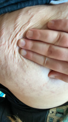 loose skin (help)