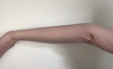 Anyone with Joint hypermobility or EDS?