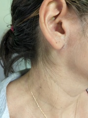 Does this look like eczema to you?