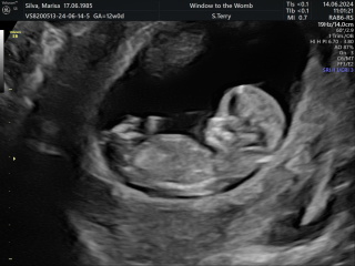 Boy or girl? 12 week scan