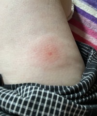 What is this thing on my leg?? A bite? Pics included!