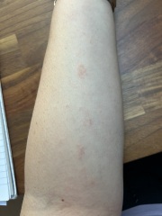 Is this eczema