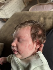 CMPA or baby acne?