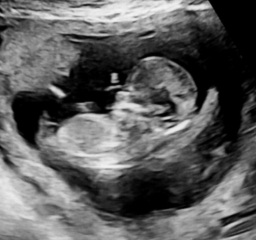 Nub or skull theory, boy or girl (twins)?!