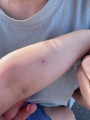 Tick bite?