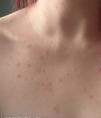 Scabies..please help me