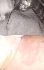 Circular rash
