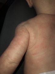 Cows milk allergy or heat rash?