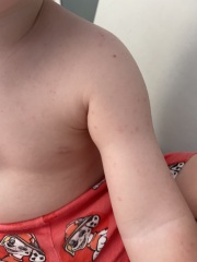 HFMD or chickenpox?