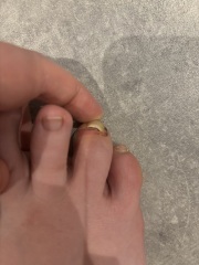Broken toe, nail about to come off!
