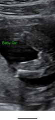 Can anyone tell gender from ultrasound scan ?