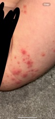 Chicken pox or HFM?
