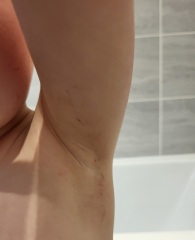 Rash on toddler