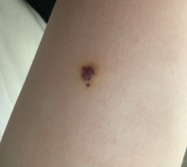 Any idea what this is on son's leg?