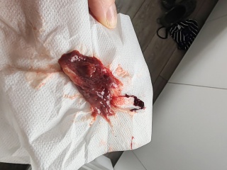 Is this a miscarriage or blood clot?