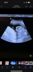 Low laying placenta???