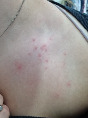 Does this look like the start of shingles?