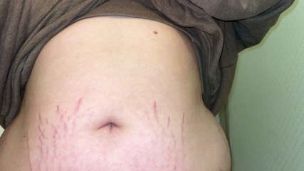 loose skin (help)