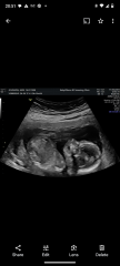 Boy or girl what do you think 😁