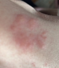 What’s this rash?