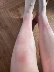 Erythema Nodosum