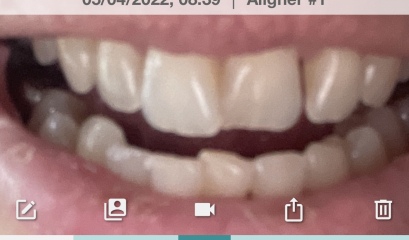 Invisalign - how much did yours cost and was it worth it?
