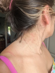 Lichen Sclerosis - anybody else?