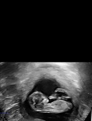 Gender guess scan at 12 weeks