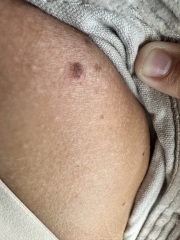 Does this mole look suspicious