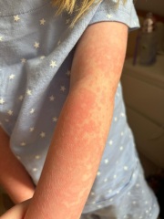 Help Diagnosing a Rash