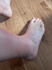 Erythema Nodosum