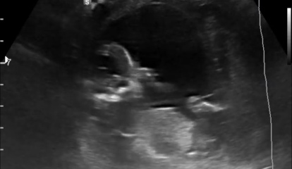 Nub / Gender - Ultrasound Tech wouldn’t commit! Opinions?