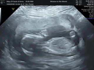 5 weeks 5 days early scan