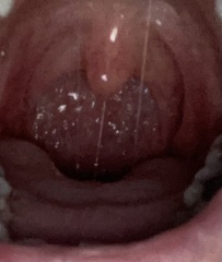 Sore throat on one side