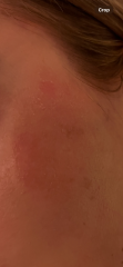 Eczema/Allergies/Diet/HRT/getting older ?