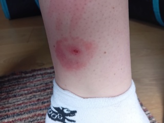 Bite