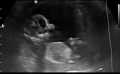 Nub / Gender - Ultrasound Tech wouldn’t commit! Opinions?