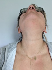 Does this look like eczema to you?