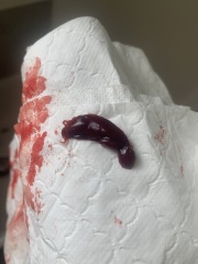 Miscarriage or period clot