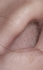 Swollen Ear Canal (Tw pics)