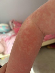 Help Diagnosing a Rash