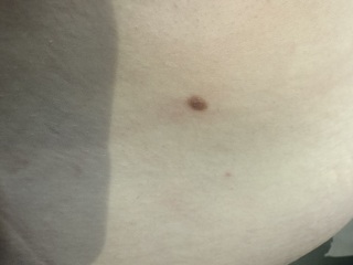 New mole - normal ?