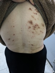 What is this on my sister’s back? Pic included