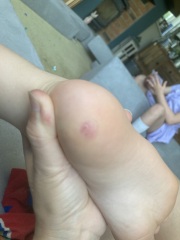 Has this verruca gone?!