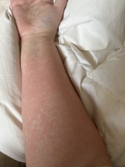 Rash and pains in all my joints