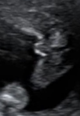 Can anyone tell gender from ultrasound scan ?